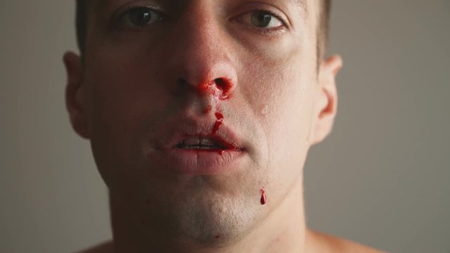 Close-Up of Man Real Nose Bleeding.