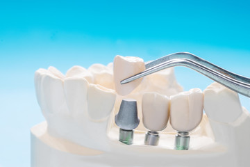 Fototapeta na wymiar Close up Implan tooth support fix bridge implan and crown.