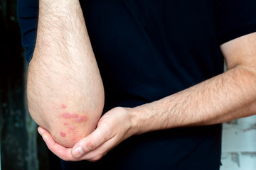 Psoriasis on the elbow. A man shows a focus of psoriasis on his body