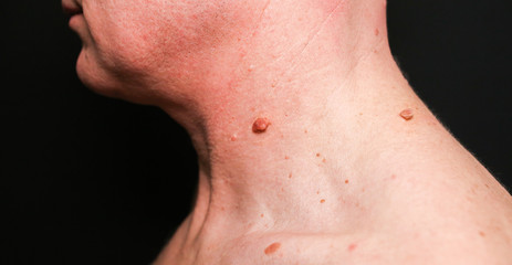 Big birthmark on the man's skin. Medical health photo. Papillomas on the neck.