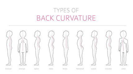 Types of kid`s back curvature. Medical disease infographic. Outline version