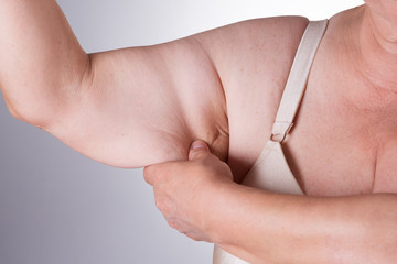 Sagging flabby skin on a woman's arm