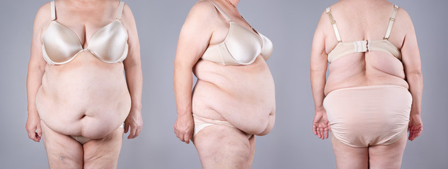 Tummy tuck, flabby skin on a fat belly and back, plastic surgery concept on gray background, collage from all sides