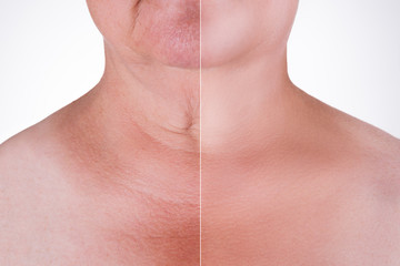 Skin rejuvenation on the neck, before after anti aging concept, wrinkle treatment, facelift and plastic surgery