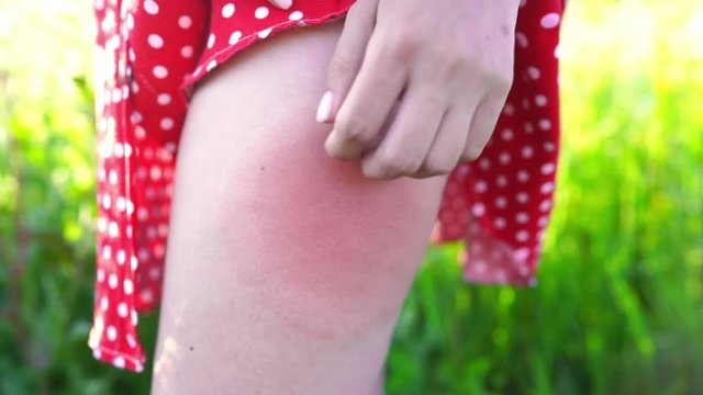 Allergic reaction on woman's leg after bee insect sting. Angioedema. Girl scratching bite under red dress