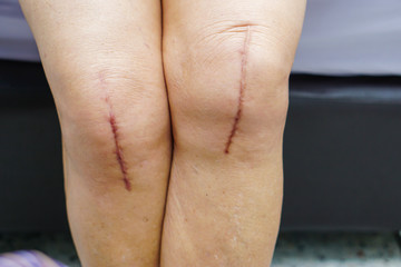 Fototapeta premium Asian senior or elderly old lady woman patient show her scars surgical total knee joint replacement Suture wound surgery arthroplasty on bed in nursing hospital ward : healthy strong medical concept.
