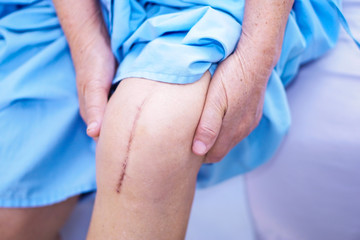 Asian senior or elderly old lady woman patient show her scars surgical total knee joint replacement...