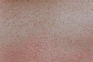 Fototapeta premium freckles on the back close up