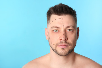 Man with marks on face for cosmetic surgery operation against blue background. Space for text