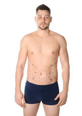 Man with marks on belly for cosmetic surgery operation against white background