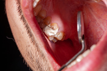 temporary filling of a tooth caries patient