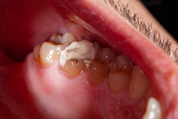 temporary filling of a tooth caries patient