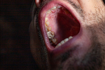 temporary filling of a tooth caries patient