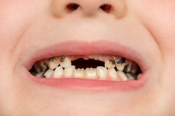Kid patient open mouth showing cavities teeth decay. Close up of unhealthy baby teeth. Dental medicine and healthcare