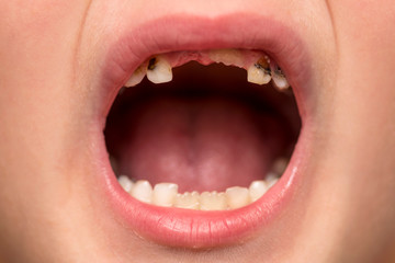 Kid patient open mouth showing cavities teeth decay. Close up of unhealthy baby teeth. Dental...