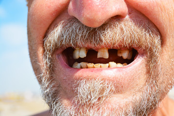 The mouth of a man in retirement age with a beard and a mustache with sick and fallen teeth. Treatment and dentistry