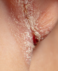 Fototapeta premium Inflamed wound in the boy's ear