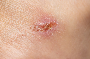 Little wound on human skin