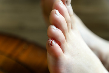 deep cut of the little finger on the leg, peeling of the nail and torn skin on the finger.