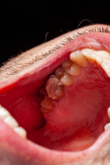 temporary filling of a tooth caries patient