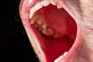 temporary filling of a tooth caries patient