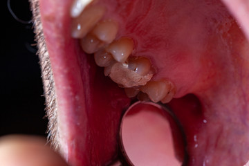 temporary filling of a tooth caries patient