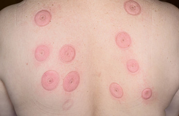 Marks on the back of aged woman from vacuum cans or jars.