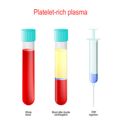 PRP. Two test tubes and syringe with blood and platelet-rich plasma.