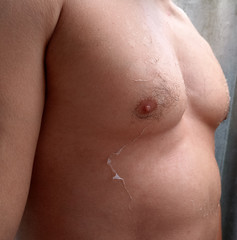 Fototapeta premium effects of sunburn on the skin. Climb skin.