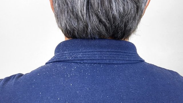 Close-up view of a man who has a lot of dandruff from his hair on his shirt and shoulders.