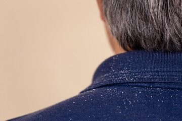 Close-up view of a man who has a lot of dandruff from his hair on his shirt and shoulders