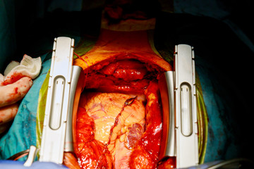 Closing chest after heart surgery