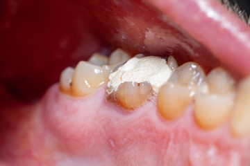 temporary filling of a tooth caries patient