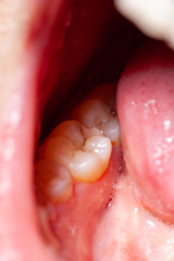 Obraz premium temporary filling of a tooth caries patient
