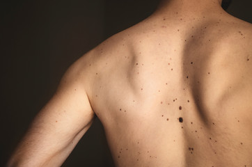 Moles on the back of a man.