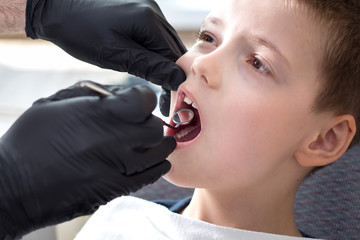 Przegląd zębów u dziecka przez dentystę. Chłopiec siedzi na fotelu dentystycznym z otwartymi ustami. Dłonie dentysty w czarnych rękawiczkach trzymają lusterko stomatologiczne - obrazy, fototapety, plakaty