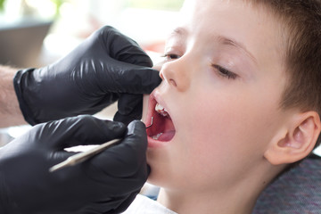 Ręce dentysty w jednorazowych czarnych gumowych rękawiczkach trzymają lusterko dentystyczne. Chłopiec w wieku szkolnym siedzi na fotelu z otwartymi ustami. Lekarz ogląda zęby chłopca.