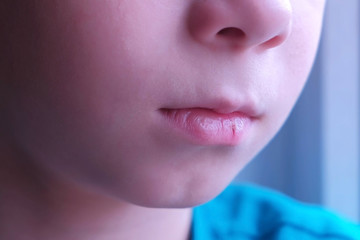 Little cut on boy's lip. Child boy with cracked dry lip, mouth closeup. Child injuries due to...