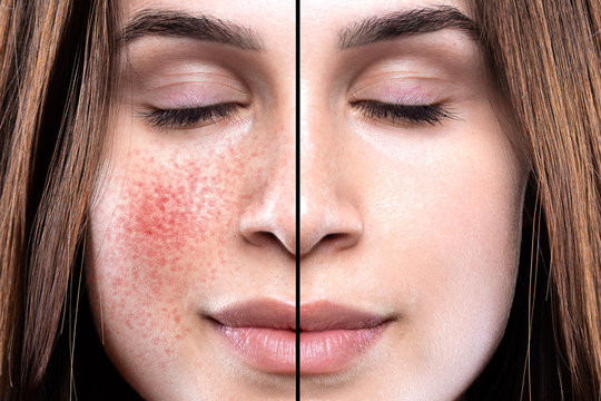A closeup portrait showing the before and results on the cheeks of a young girl who suffers from rosacea. Intensive light treatment successfully clears the symptoms.