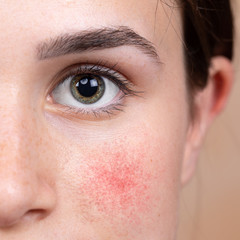 A young Caucasian girl in her early 20s is seen up close. Details of the green iris and eye area. Rosy cheek is seen with small red blotches. Symptomatic of rosacea, a common skin complaint.