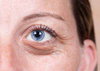 A close-up view on the blue eye of a forty something Caucasian lady with a swollen and dark bag...