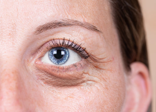 A close-up view on the blue eye of a forty something Caucasian lady with a swollen and dark bag beneath the eye. Fluid retention in delicate skin through aging and tiredness.