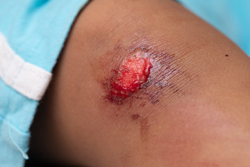 An extreme close up view on the bloody grazed leg of an innocent young child. Injury sustained from playing outdoors.