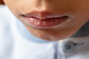 A closeup view on the painful and blistered lips of a young child. Dry and cracked skin is seen at...