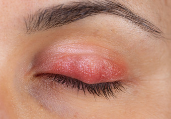 Macro view of a woman's eye with swollen and inflamed eyelid, symptomatic of a painful infection of...