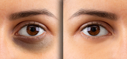 A macro view on the eye of a young lady. Showing before and after suffering from dark circles...