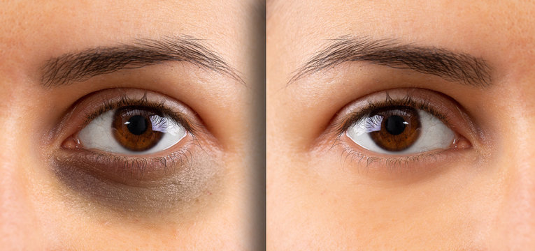 A macro view on the eye of a young lady. Showing before and after suffering from dark circles beneath the eye. Bruising is seen on the left and flawless complexion on the right.
