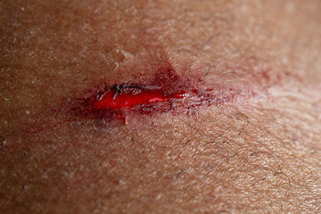 A macro view of a deep and bloody cut on human skin. Painful and deep laceration requires medical...