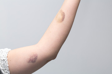 A closeup view on the arm of a Caucasian woman isolated against a clean background. She holds arm...