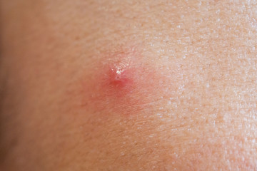 Inflammatory acne with red spot on face closeup